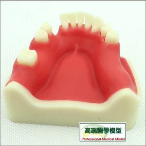 口腔種植仿真下頜骨附牙齦模型種植體牙醫齒科牙齒模型